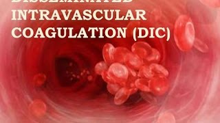 Disseminated Intravascular Coagulation [upl. by Nolaf]