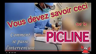 Pose de picline Lintervention en détail 🦀 CANCER DU SEIN [upl. by Collier]