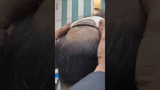 Permanent hair patch delhi  Best hair patch for mens hairfixing hairtutorial [upl. by Nizam141]