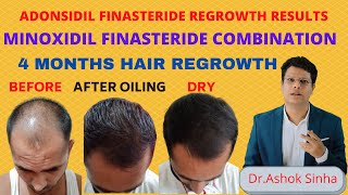 Best Hair Regrowth Treatment For Men [upl. by Adirf]