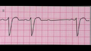 Bloc auriculoventriculaire de 2ème degré Mobitz type 2 [upl. by Brianne]