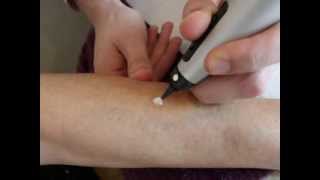 Treatment of a pigmentation spot with cryotherapy  Cryopen [upl. by Shaina]