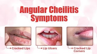 Angular Stomatitis  Cheilosis  Angular Cheilitis  Causes symptoms and Treatment [upl. by Hgielak402]