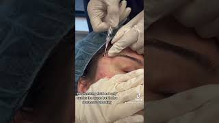 Subcision for Acne Scars of the Cheeks and Temples [upl. by Aicenra]