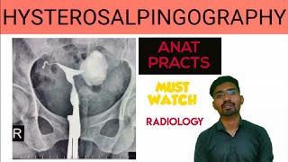 Hysterosalpingography  Anatomy  Radiology  Ft Dishant [upl. by Halona]