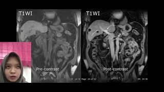 Agent contrast Gadolinium in MRI [upl. by Natalia]