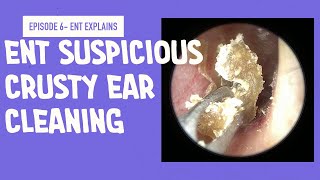 Crusty Ear Cleaning Investigating why young patient has hearing loss Episode 6 [upl. by Chryste]