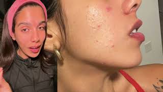 Clear Skin Secrets How Blue Light Therapy Erased My Acne [upl. by Aleiram]