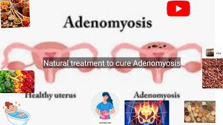 Natural treatment of Adenomyosis in the English languageadenomyosis [upl. by Attelrahc]