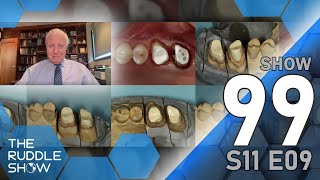 S11 E09  Restoring EndodonticallyTreated Teeth Special Presentation by Dr Gordon Christensen [upl. by Kimmel]