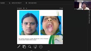 The versatility of Bleomycin the wonder by Dr Rajiv Agarwal Plastic Surgery and Burns SGPGIMS [upl. by Bellis391]