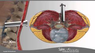 Lumbar Microdiscectomy  Spine Center Northern Nevada Northern California  Spine Surgery [upl. by Nereus]