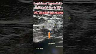 Acute Epiploic Appendigitis medical radiology ultrasound doppler acuteappendicitis shorts [upl. by Arhsub447]