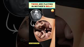 Twins movement in the womb  Fetal movement  Baby Kicks shortsvideo pregnancy love [upl. by Ahseena]