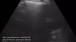 CASE 619 LUNG ULTRASOUND PULMONARY FIBROSIS B LINES [upl. by Decato279]