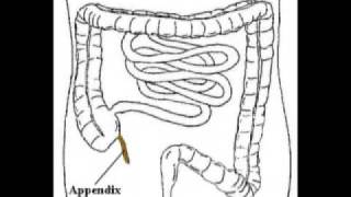 Appendicitis Treatment  Dr Schultzs quotThe Cause of Diseasequot Pt1 [upl. by Arabelle360]