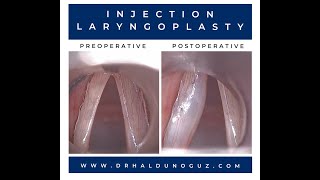 Management of Unilateral Vocal Fold Paralysis [upl. by Pellegrini]