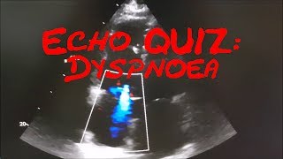 Cardiology Echo QuizCase Which EchoSign do you see here and what is your diagnosis [upl. by Tallu]