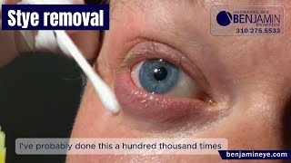 Eye Styes Removal at Benjamin Eye Institute [upl. by Patin]