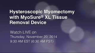 Hysteroscopic Myomectomy with MyoSure® XL Tissue Removal Device [upl. by Conni]