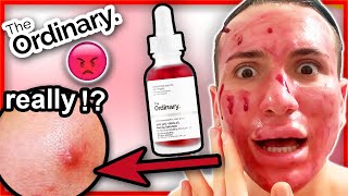 I tried The Ordinary AHA 30  BHA 2 PEELING SOLUTION for 4 WEEKS [upl. by Joachima]