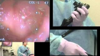 Colonoscopy  consecutive cases 620 [upl. by Dnanidref73]