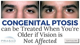 How Correcting Congenital Eyelid Ptosis can be Delayed as Long as Vision is Not Affected [upl. by Noisla]