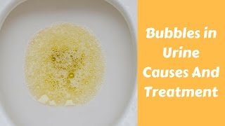 Bubbles in Urine Causes And Treatment [upl. by Couture131]