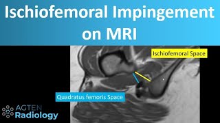 Ischiofemoral impingement on MRI [upl. by Follmer]