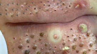 Big Cystic Acne Blackheads Extraction Blackheads amp Milia Whiteheads Removal Pimple Popping  703 [upl. by Lore]