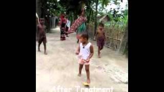 Walk For Life Clubfoot Bangladesh Happy StoryUrmi [upl. by Garceau]