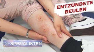 Beulen an den Beinen Parasitenbefall  Auf Streife  Die Spezialisten  SAT1 TV [upl. by Philis]