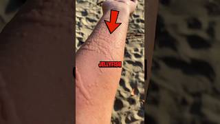 How To Survive a Jellyfish Sting 😨 [upl. by Remark]