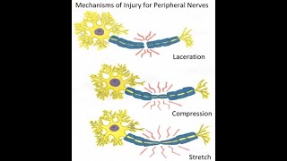 Peripheral nerve injuries classification and Wallerian degeneration [upl. by Haraz]