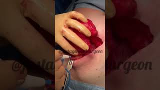 Inside the OR with justageneralsurgeon  excision of huge lipoma fatty tumor with specimen slam [upl. by Ihcelek]