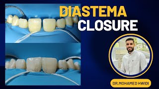 Diastema closure with composite [upl. by Shaun]