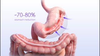 ESG Animation Endoscopic Sleeve Gastroplasty [upl. by Nappy609]