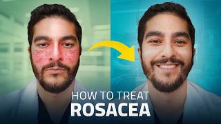 Struggling with Rosacea Here Are the Best Treatments for 2024 [upl. by Badr]