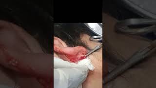 Ear lobule cyst  pus inside cyst  shorts [upl. by Storm]