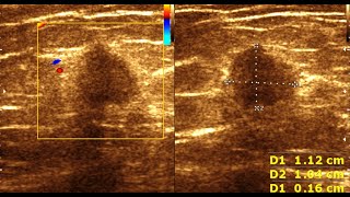 Breast Carcinoma  Fibroadenoma Breast  Benign Vs Malignant Breast Masses [upl. by Nylave]