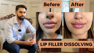 Dissolving Lip Filler  Amazing Results [upl. by Oiramat]