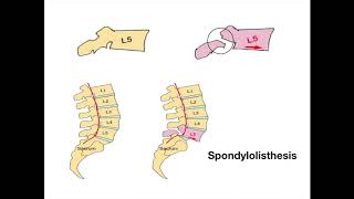 Spondylolisthesis [upl. by Lesh798]