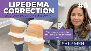 Lipedema Liposuction Demonstration  One Day Post Op Follow Up  Salameh [upl. by Lienahs143]