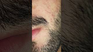 ingrown hair removal removery hairstyle satisfying [upl. by Einner428]