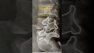 Spondylolisthesis medicalcollege neetpg inicet [upl. by Aubyn]