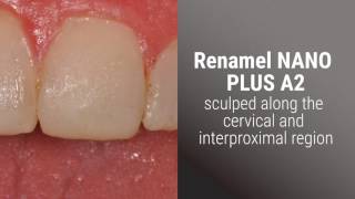 OPTIMIZING ANTERIOR ESTHETICS WITH COMPOSITE [upl. by Eanom]