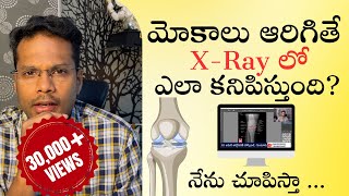 Osteoarthritis knee  Xray changes  Staging explained  Telugu  Dr Ramprasad Kancherla [upl. by Eseenaj]