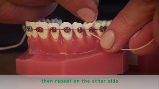 HOW TO FLOSS BRACES [upl. by Adnohsar]