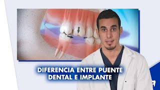 ¿Cuál es la diferencia entre un IMPLANTE dental y un PUENTE dental  Shorts [upl. by Noneek877]