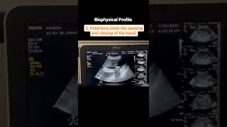 Components of a Biophysical Profile [upl. by Adiesirb]